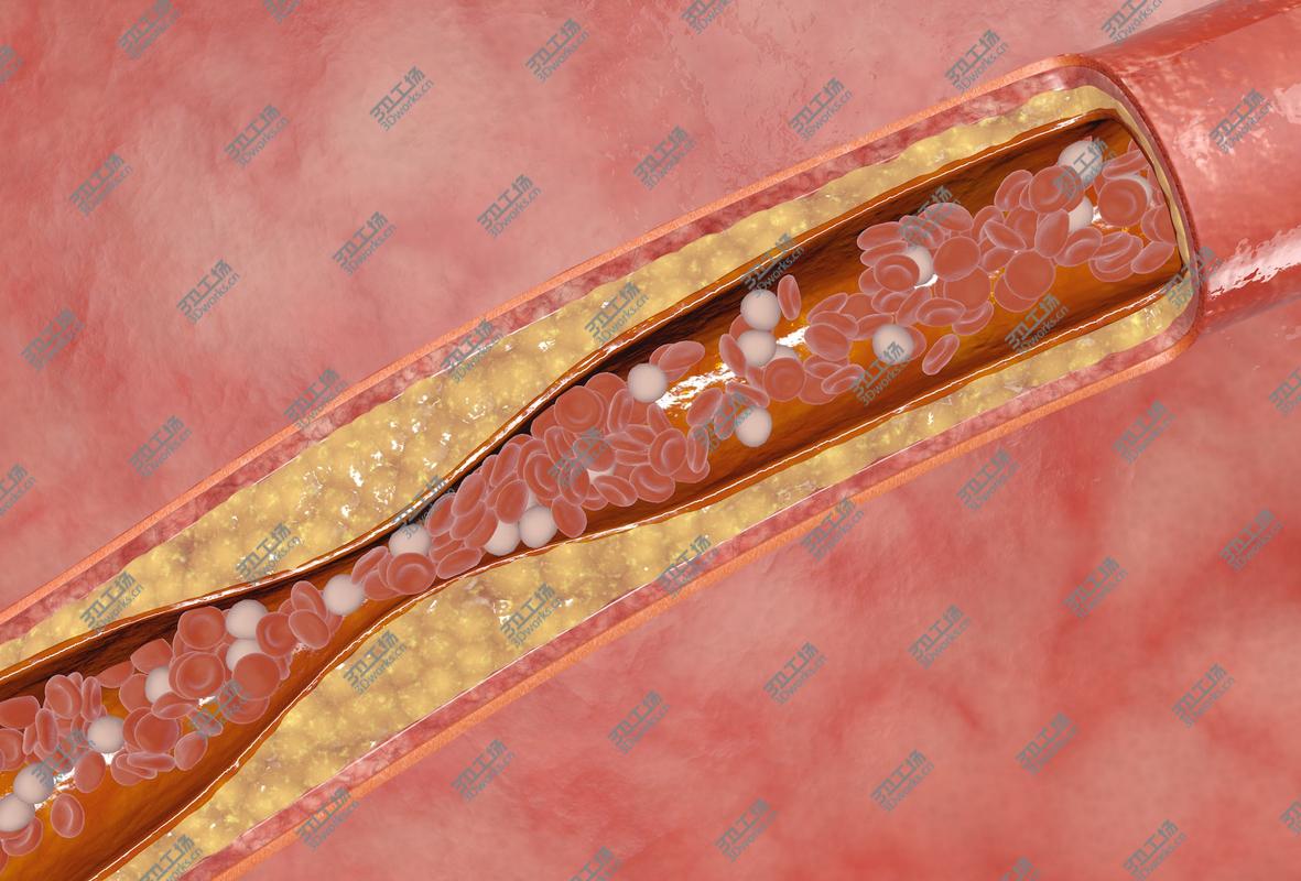 images/goods_img/2021040232/blocked blood vessel animation 3D model/2.jpg